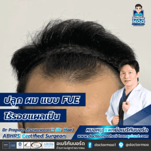 ปลูกผมแบบ Fue ไร้รอยแผลเป็น