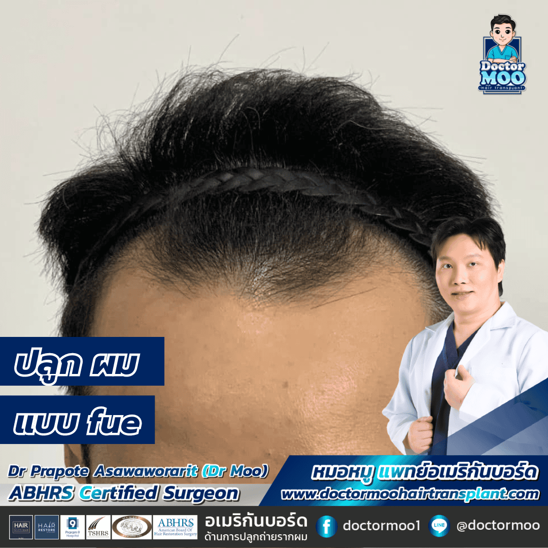 ปลูกผมแบบ FUE