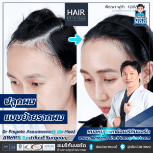 ปลูกผมแบบย้ายรากผม