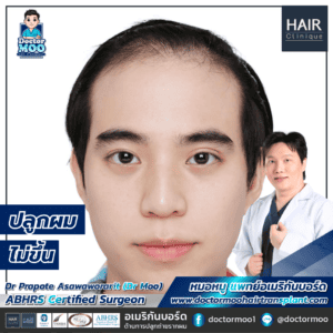 ปลูกผมไม่ขึ้น