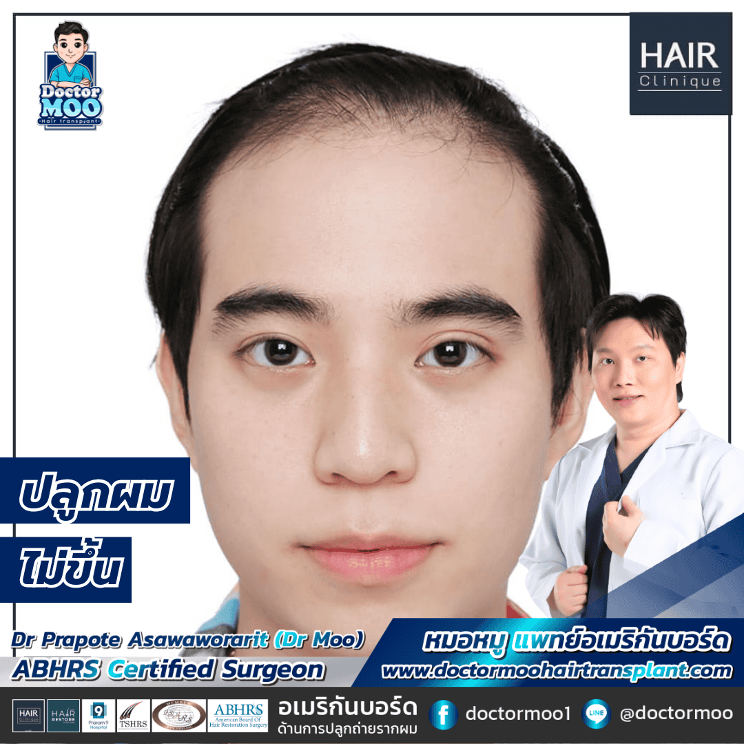 ปลูกผมไม่ขึ้น