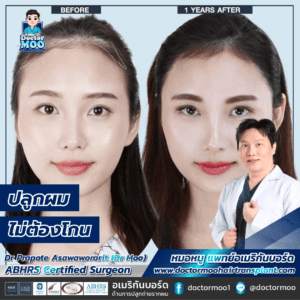 ปลูกผมไม่ต้องโกน