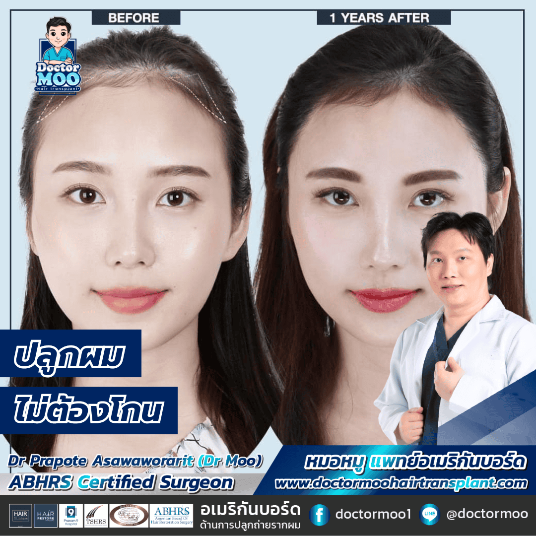 ปลูกผมไม่ต้องโกน