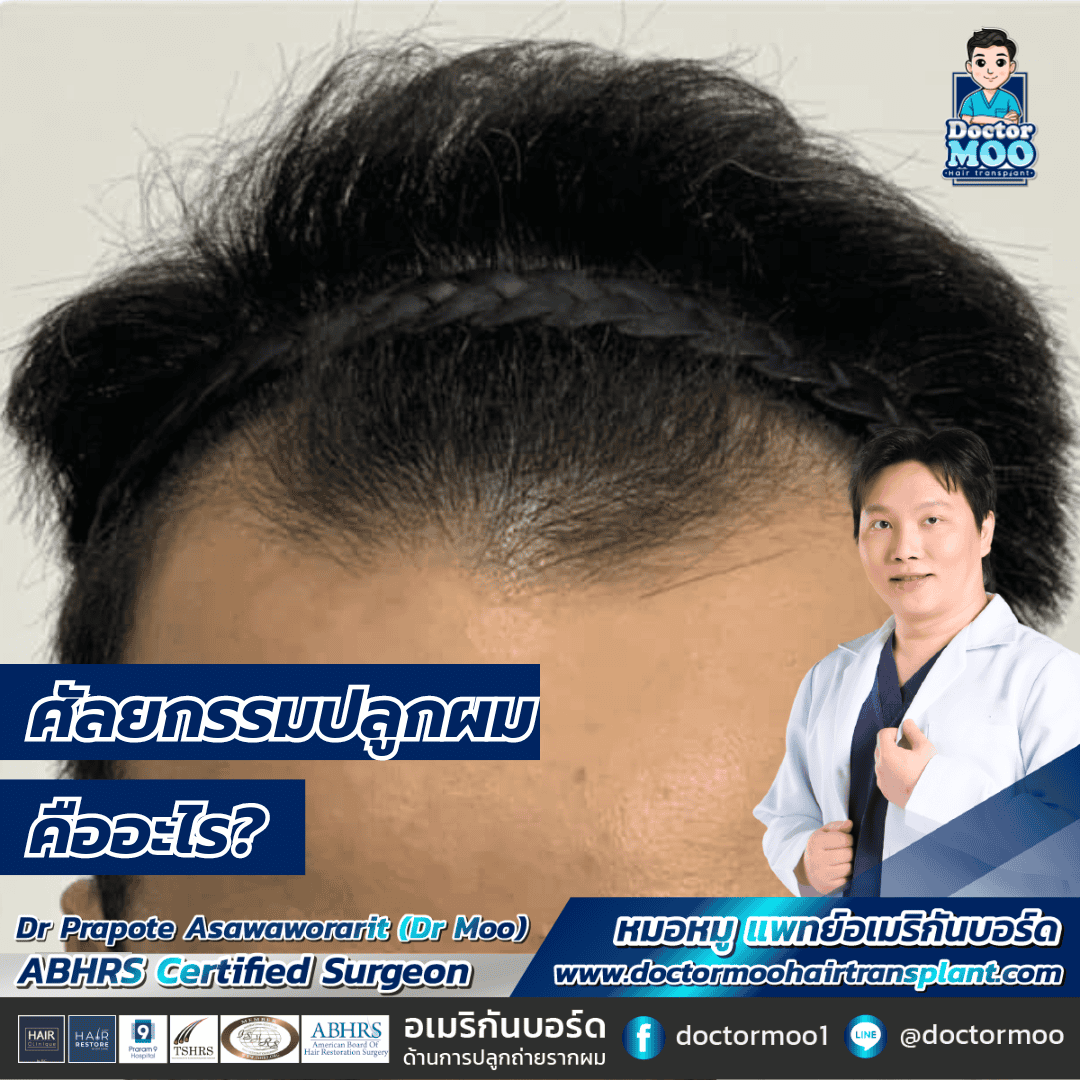 ศัลยกรรมปลูกผม คืออะไร