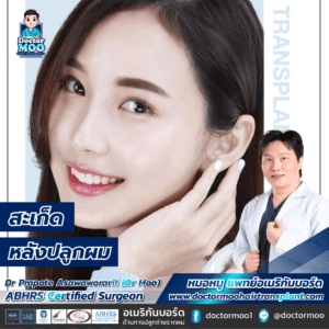 สะเก็ดหลังปลูกผม