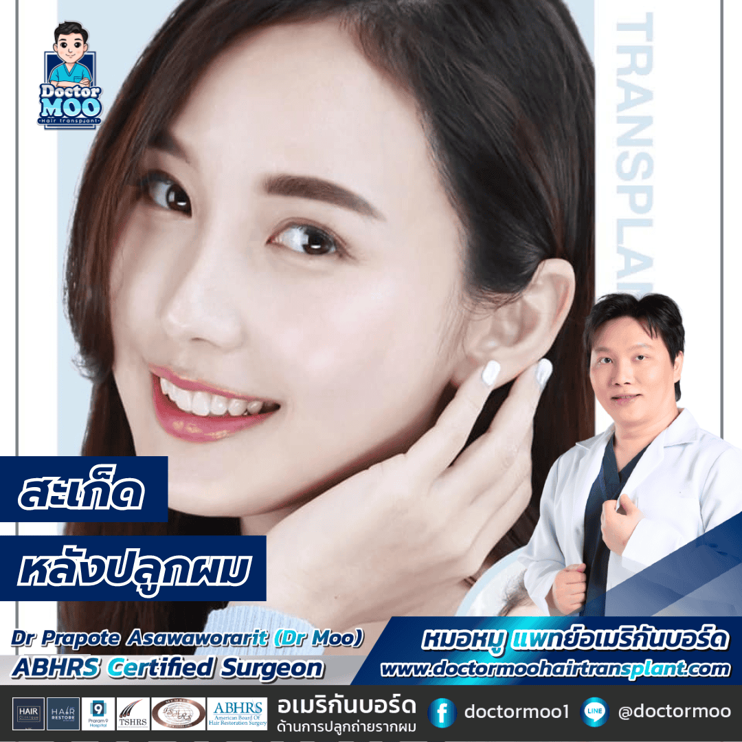 สะเก็ดหลังปลูกผม