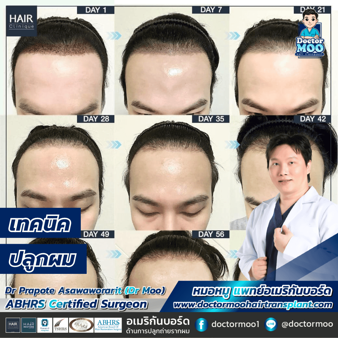 เทคนิคปลูกผม