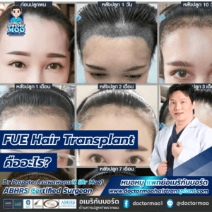 FUE Hair Transplant คืออะไร