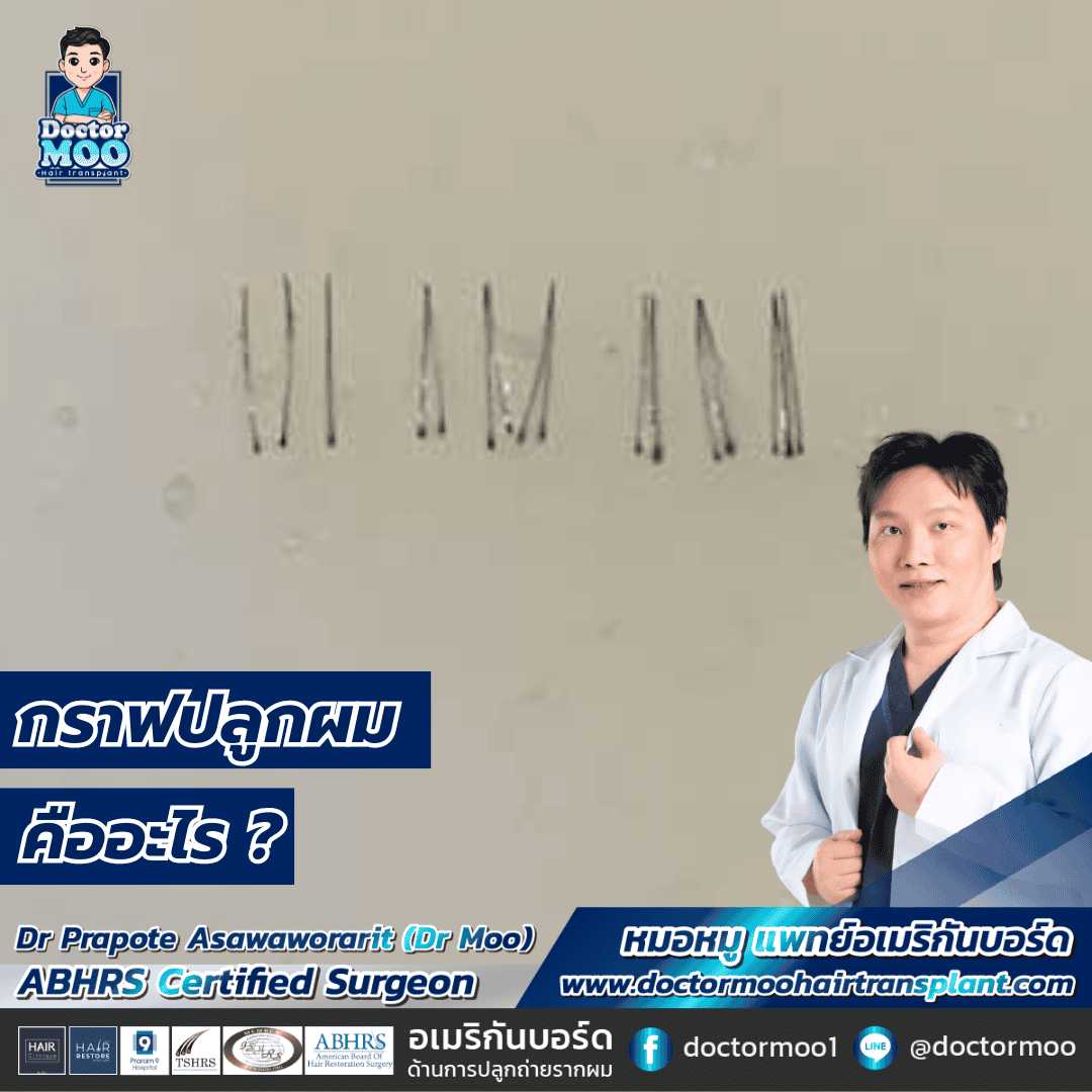 กราฟปลูกผม คืออะไร