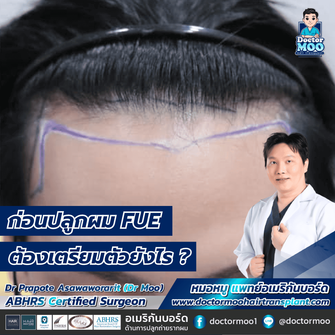 ก่อนปลูกผม FUE ต้องเตรียมตัวยังไร