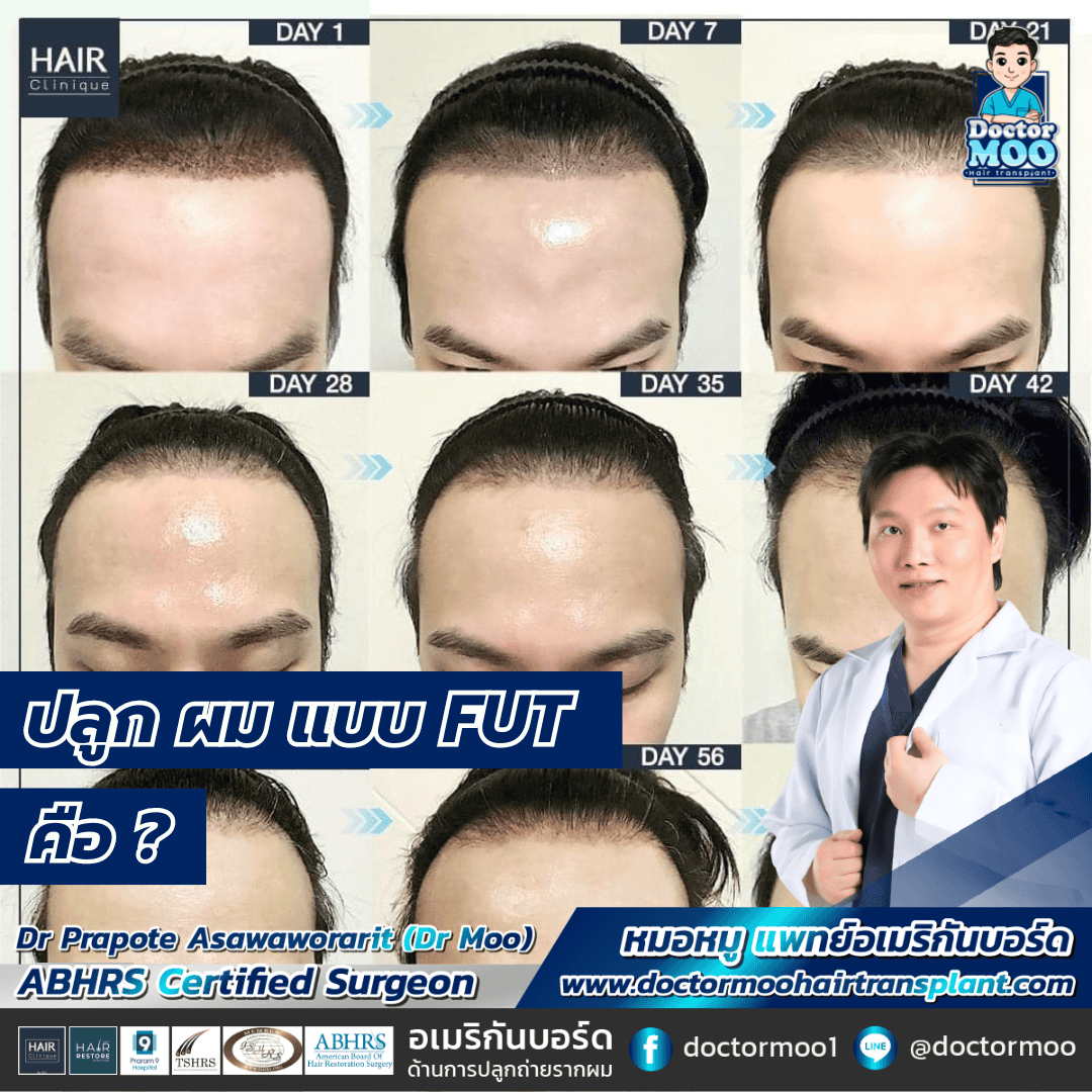 ปลูก ผม แบบ FUT คือ
