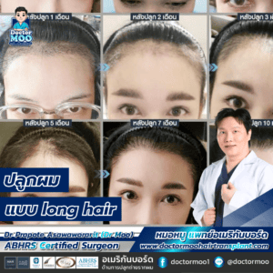 ปลูก ผม แบบ long hair
