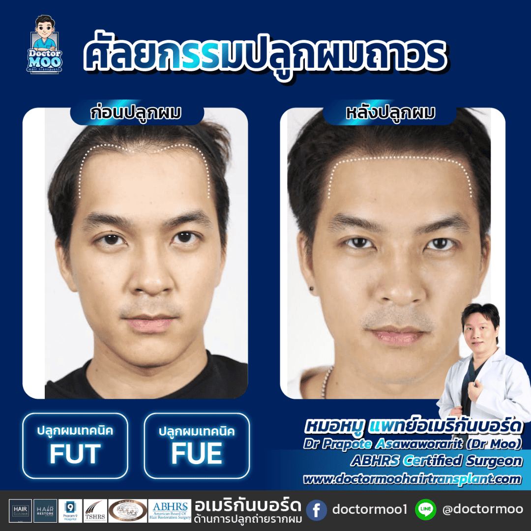 ปลูกผม FUE คืออะไร