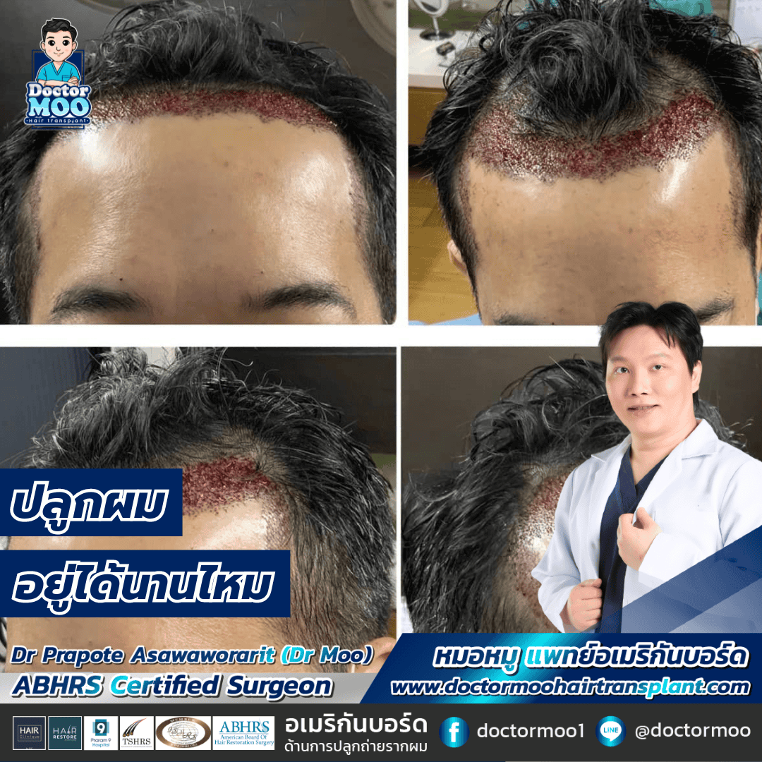 ปลูกผม อยู่ได้นานไหม