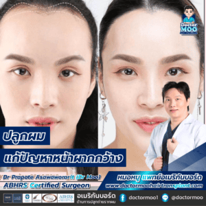 ปลูกผม ปรับกรอบหน้าผู้หญิง