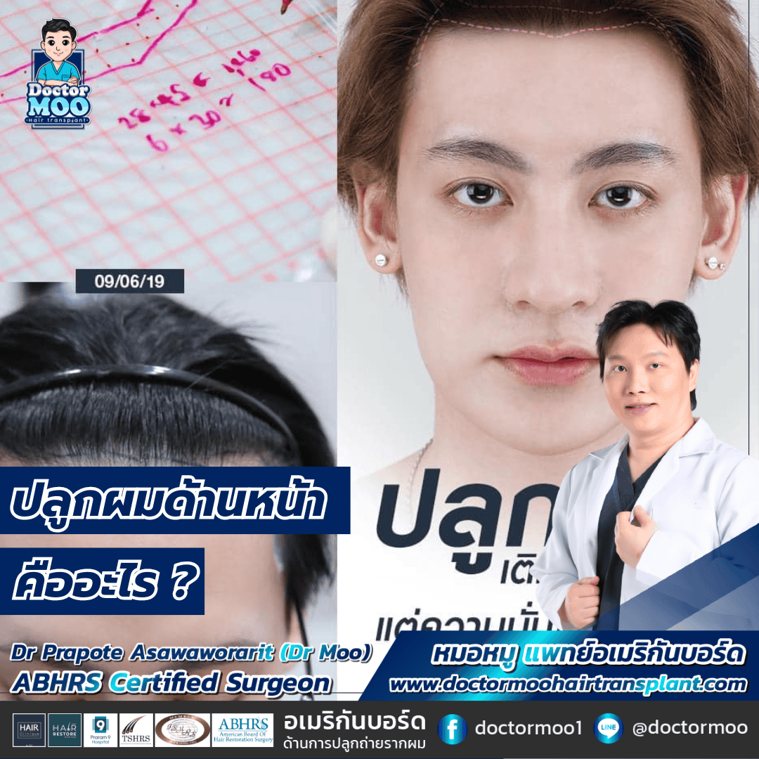 ปลูกผมด้านหน้า