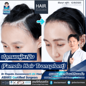 ปลูกผมผู้หญิง (Female Hair Transplant)