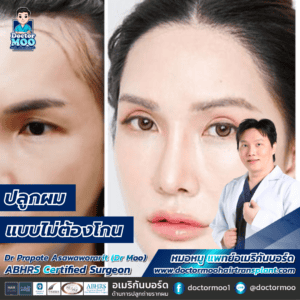 ปลูกผมแบบไม่ต้องโกน!