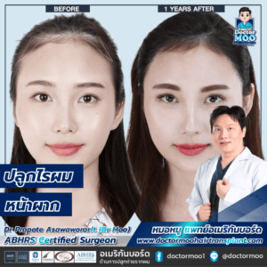 ปลูกผมผู้หญิง ใช้เวลานานแค่ไหน