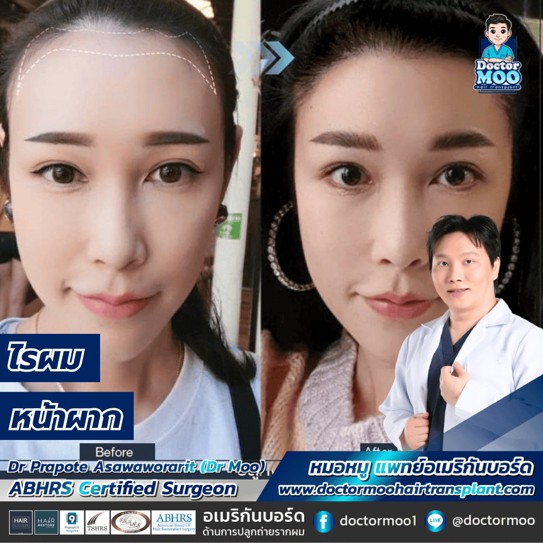 ปลูกผมผู้หญิง ใช้เวลานานแค่ไหน