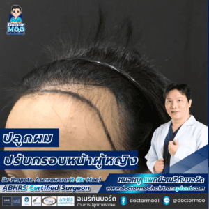ปลูกผม ปรับกรอบหน้าผู้หญิง