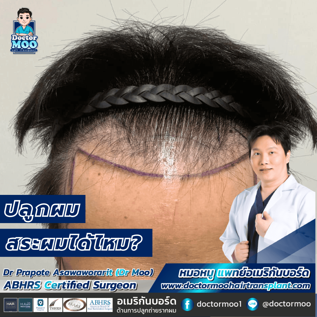 ปลูกผม สระผมได้ไหม