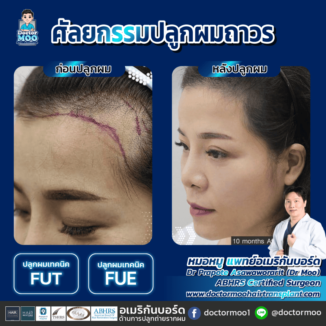 ปลูกผม ปรับกรอบหน้าผู้หญิง