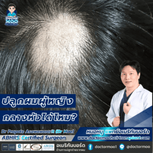 ปลูกผมผู้หญิง กลางหัวได้ไหม