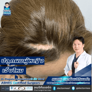 ปลูกผมผู้หญิง เจ็บไหม