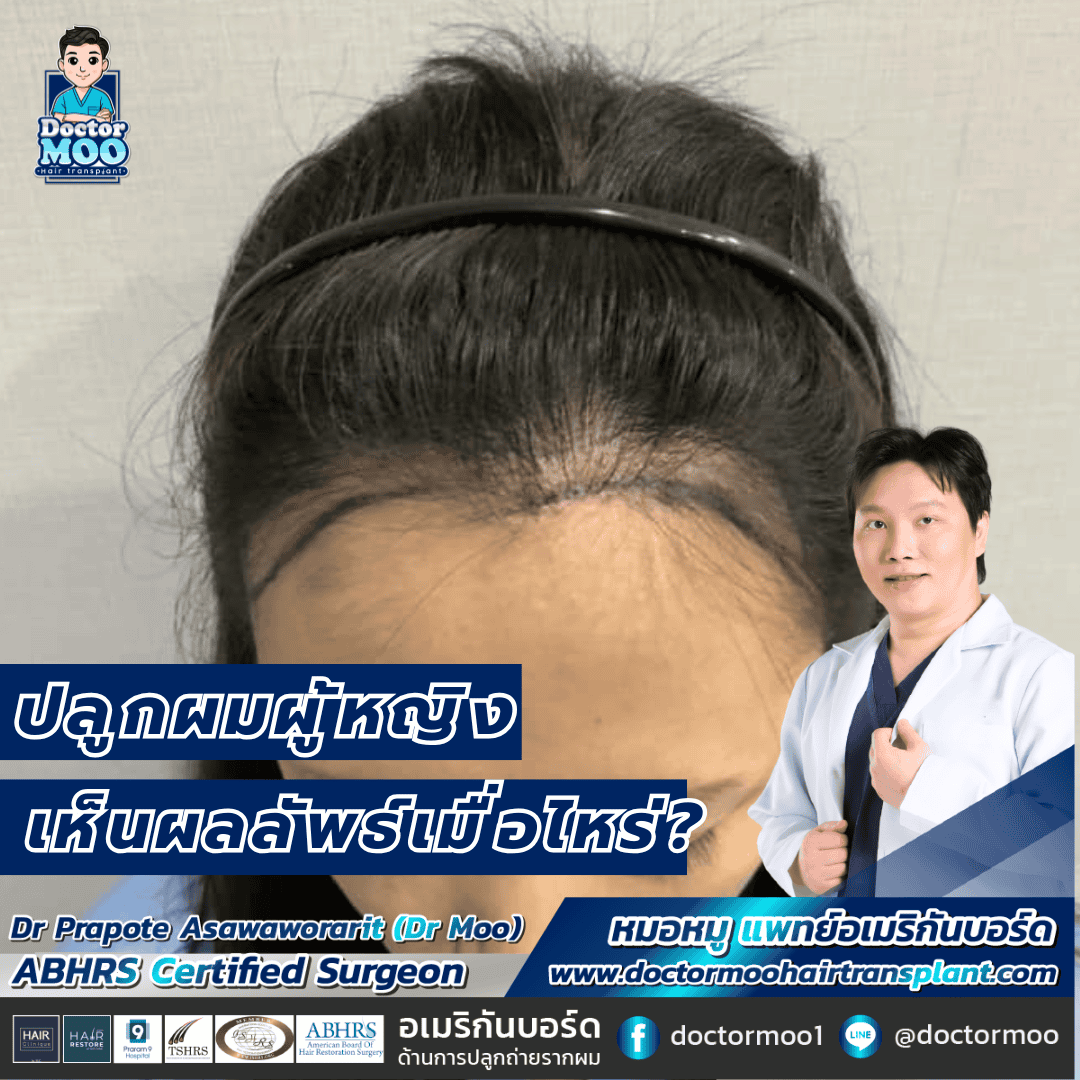 ปลูกผมผู้หญิง เห็นผลลัพธ์เมื่อไหร่